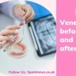 Veneers Before and After: How Can Fix Common Dental Issues